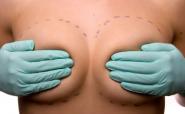 Breast augmentation – saline versus silicone implants – The Beauty Biz